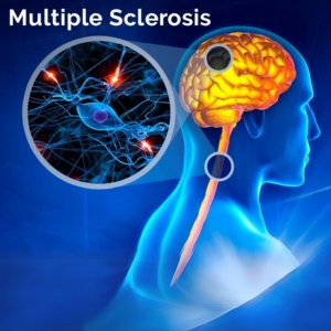 Multiple Sclerosis Treatment in Hyderabad - Dr Soumya Neurologist Hyderabad - CANES Clinic